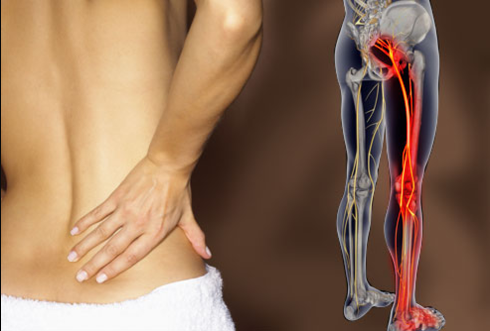 sciatica